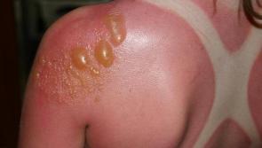 Kilkenny People urged to be careful in the sun - Five easy steps for protection