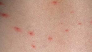 HIQA asks Kilkenny parents to have their say on adding chicken pox jab to vaccine schedule