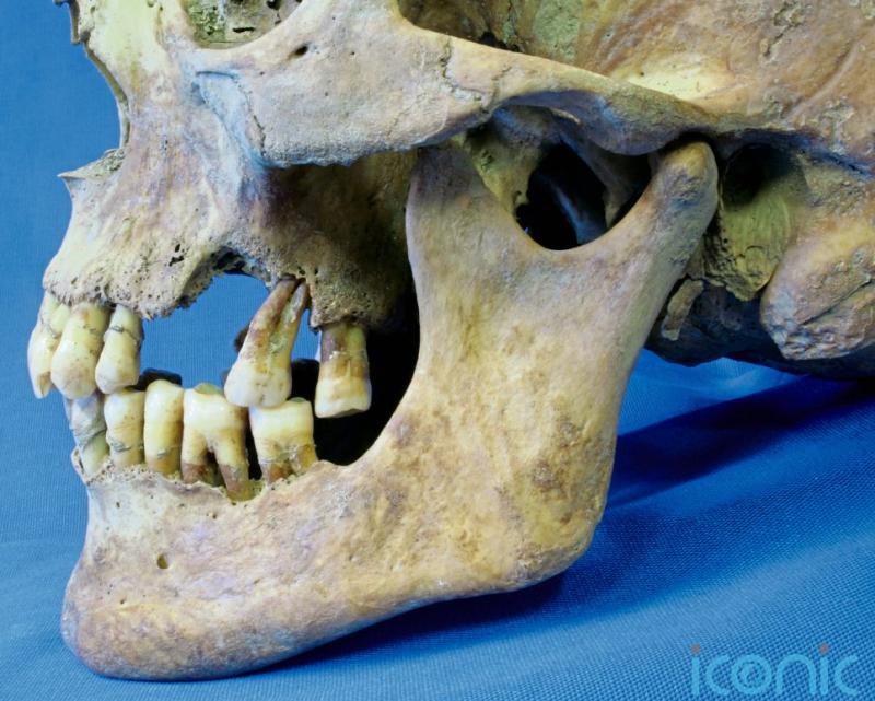 Dental remains exhumed in Kilkenny reveal a lot about Famine diets