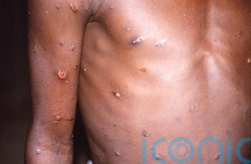 No monkeypox cases in Ireland or NI despite dozens across UK and Europe